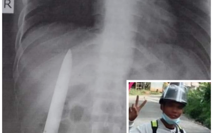 <p><strong>EMBEDDED BLADE.</strong> An X-ray shows a four-inch kitchen knife blade inside the right abdomen area of 25-year-old Kent Ryan Tomao from Kidapawan City. He went to a radio station Wednesday (March 24, 2021) to seek help from Good Samaritans for his plight. <em>(Photo courtesy of DXND Kidapawan)</em></p>