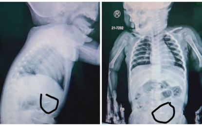 <p><strong>SWALLOWED PIN.</strong> The X-ray result of a nine-month-old boy who accidentally swallowed a pushpin in Kidapawan City, North Cotabato on Tuesday (Sept. 28, 2021). The child’s mother, Angel Mae Dinaguit, is appealing for help for her son’s operation estimated to cost PHP100,000. <em>(Photo courtesy of Angel Mae Dinaguit)</em></p>