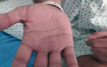 Contact tracing on after suspected monkeypox case in NegOr