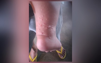 <p><strong>OUTBREAK</strong>. Blistering is one of the symptoms of the highly-contagious hand, foot, and mouth disease (HFMD). The disease has already affected 33 villages in Borongan City, Eastern Samar province, prompting the city government to declare an outbreak. <em>(PNA file photo)</em></p>