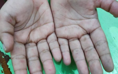 <p><strong>CONTAINED</strong>. Hand blisters are among the signs of hand, foot and mouth disease (HFMD). The Provincial Health Office Provincial Epidemiology and Surveillance Unit information showed the 2,407 HFMD cases from Jan. 1 to Feb. 25 this year have all recovered. <em>(PNA file photo)</em></p>