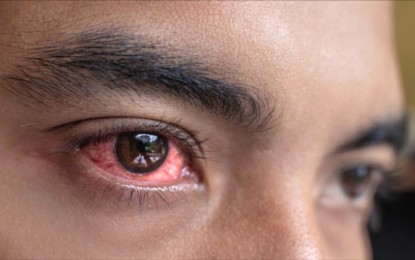 <p><strong>RED EYES.</strong> The Department of Health (DOH) in Abra recorded about 600 conjunctivitis or sore eyes cases following the series of inclement weather that affected the province recently. Dr. Lilibeth Martin, DOH-Abra provincial head, reiterates Thursday (Sept. 28, 2023) that hand hygiene remains the primary solution to prevent the further spread of the bacteria. <em>(PNA photo by Christian Allister Tubadeza)</em></p>