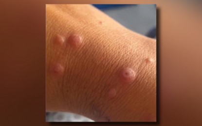 DOH in Ilocos calls for vigilance vs. Mpox