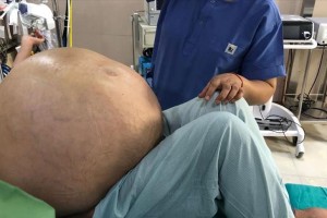 Doctors remove world’s largest tumor in India