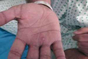 DOH says no new cases of monkeypox in PH