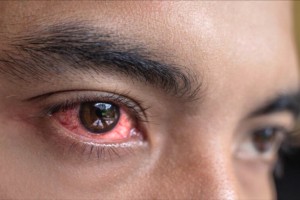 'Sore eyes' cases spike in Abra