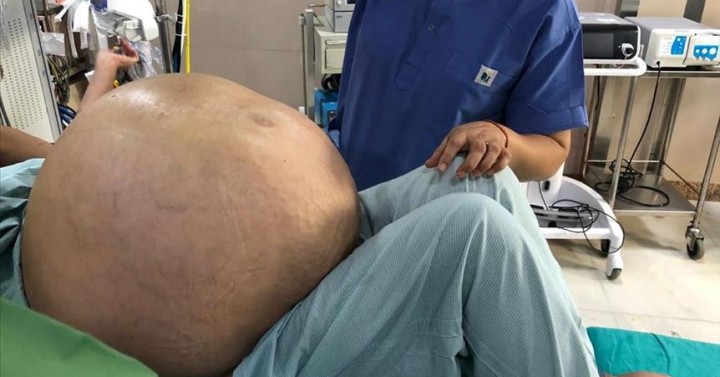 Doctors Remove Worlds Largest Tumor In India Philippine News Agency